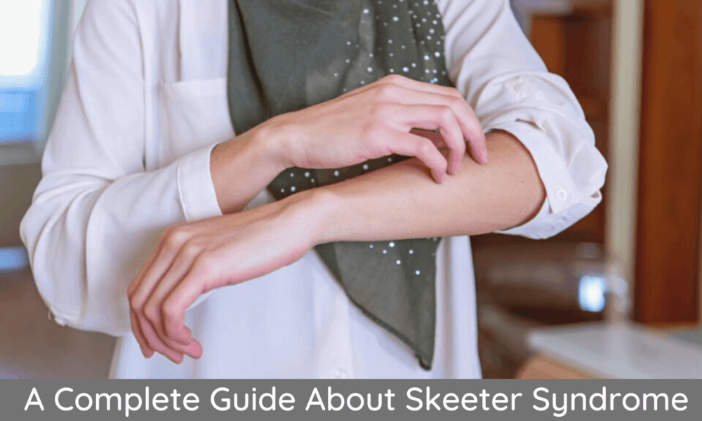 A Complete Guide About Skeeter Syndrome