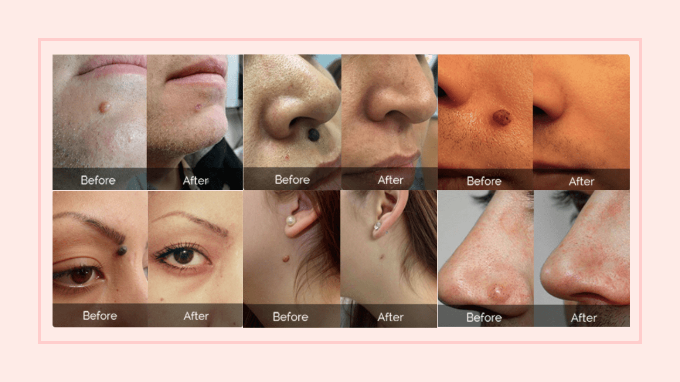 Amarose Skin Tag Remover Results