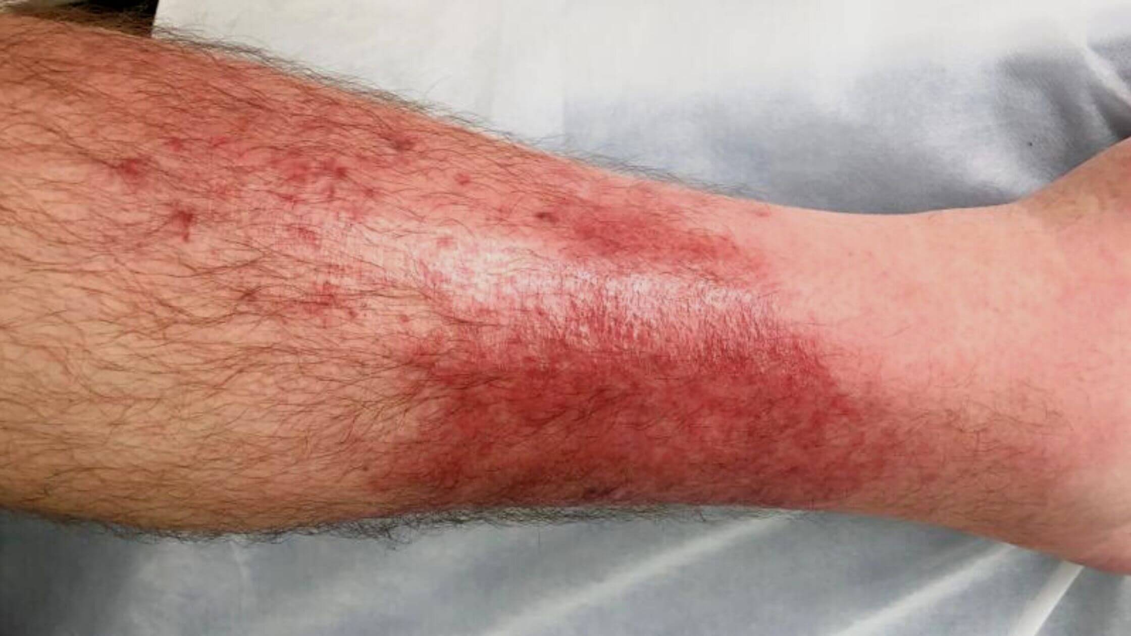 Cellulitis