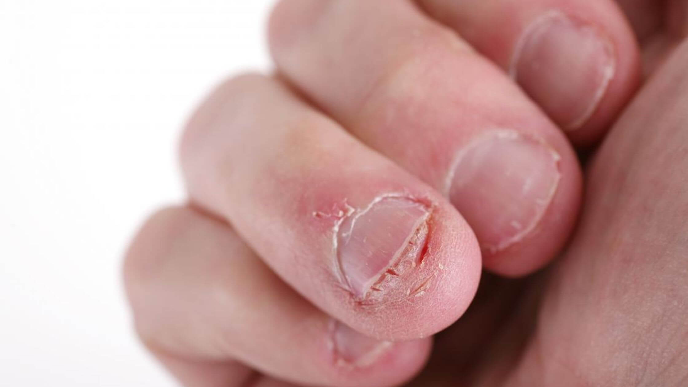 Fingernails That Grow At An Irregular Pace   