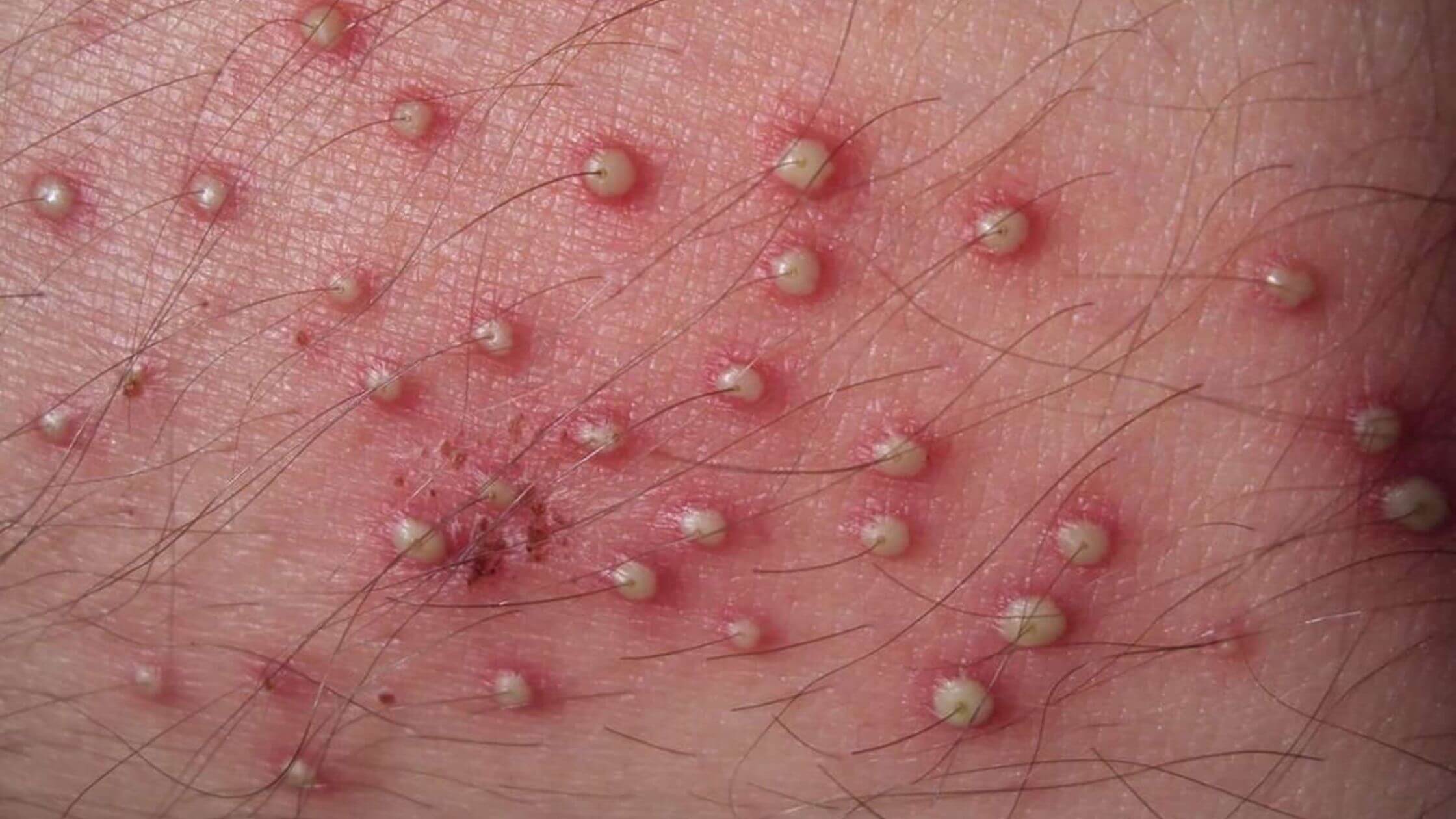 Folliculitis