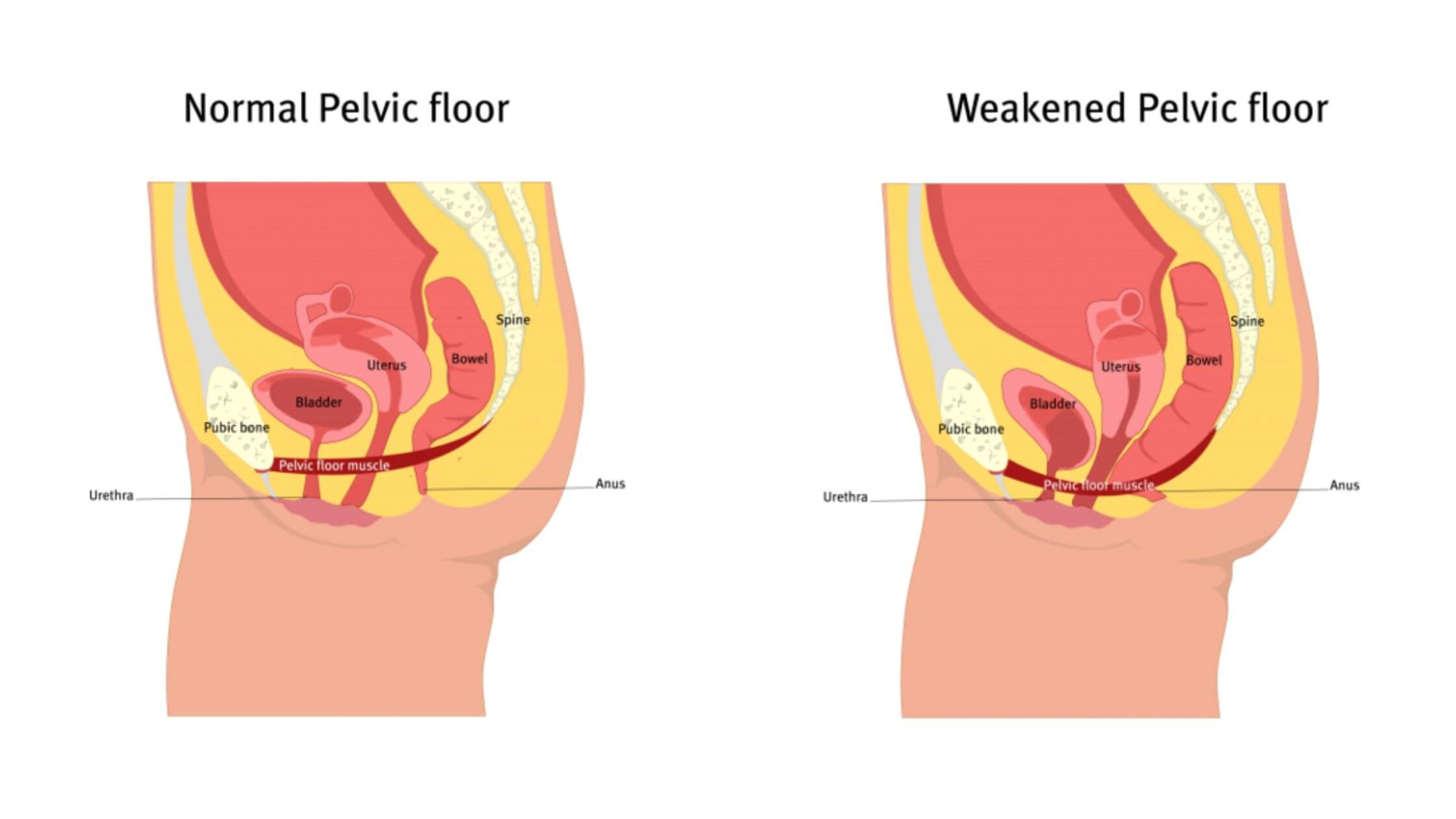 High Tone Disorders