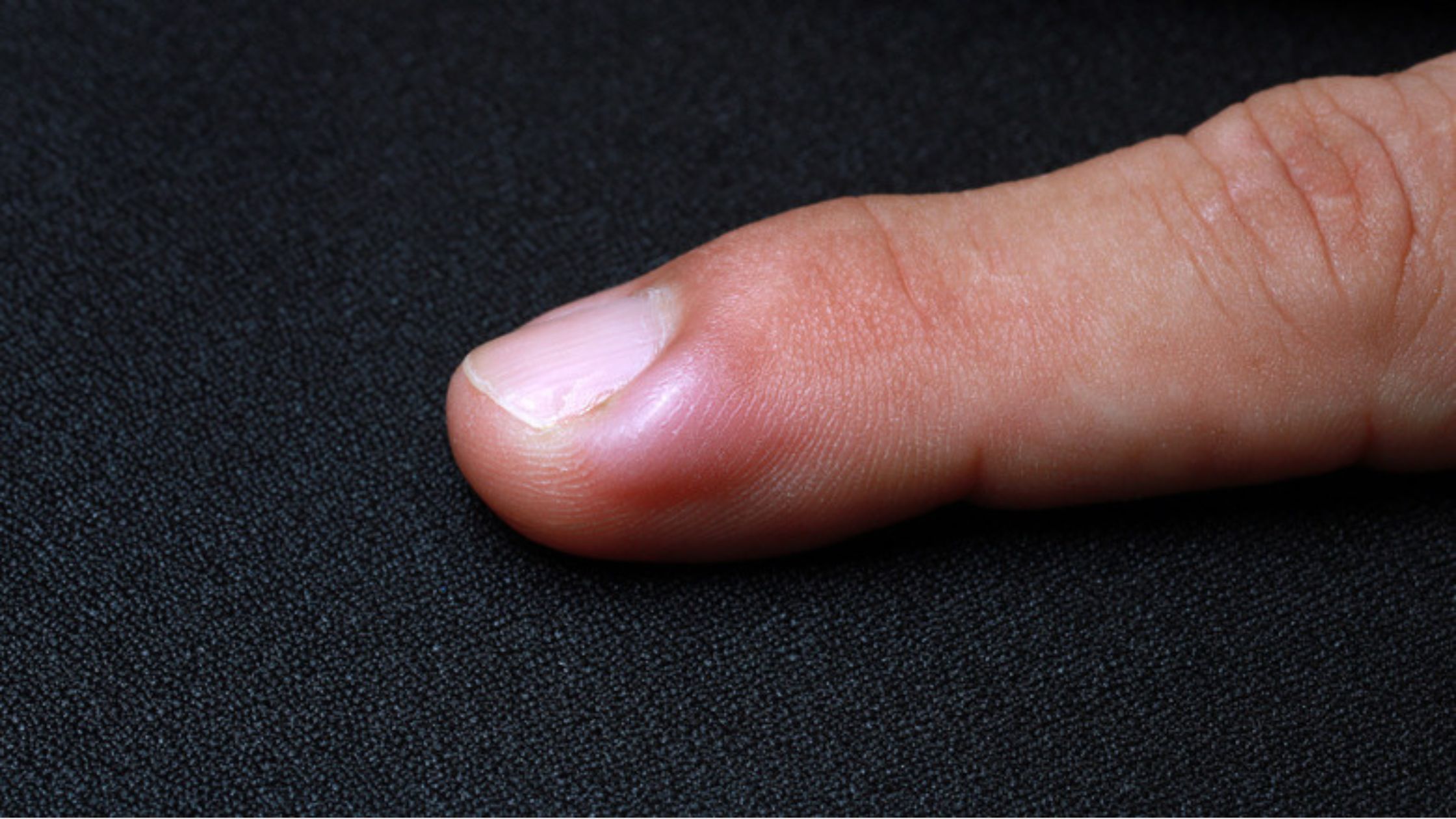 Home Remedies To Fix Ingrown Fingernails