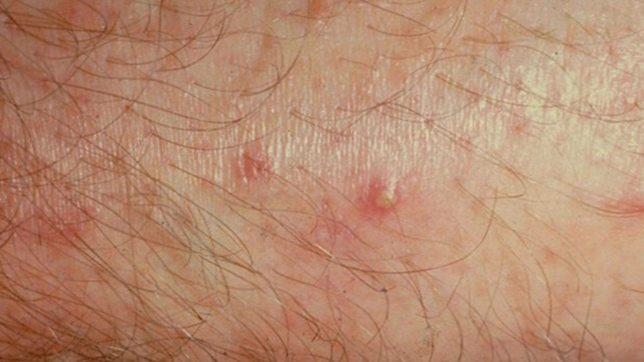 Bacterial Skin Rash - Causes, Remedies, And Treatments Revealed!