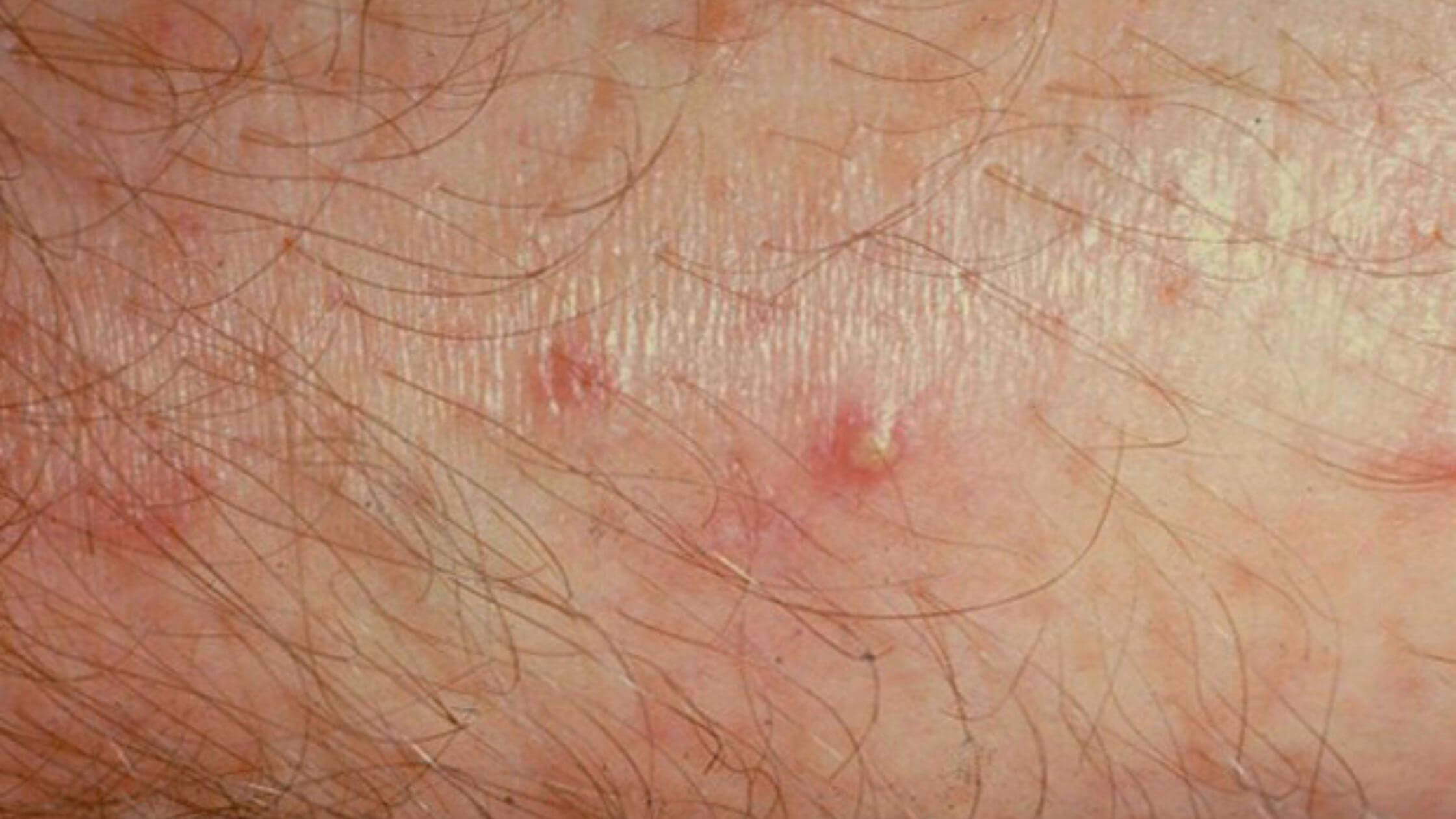 Hot Tub Folliculitis