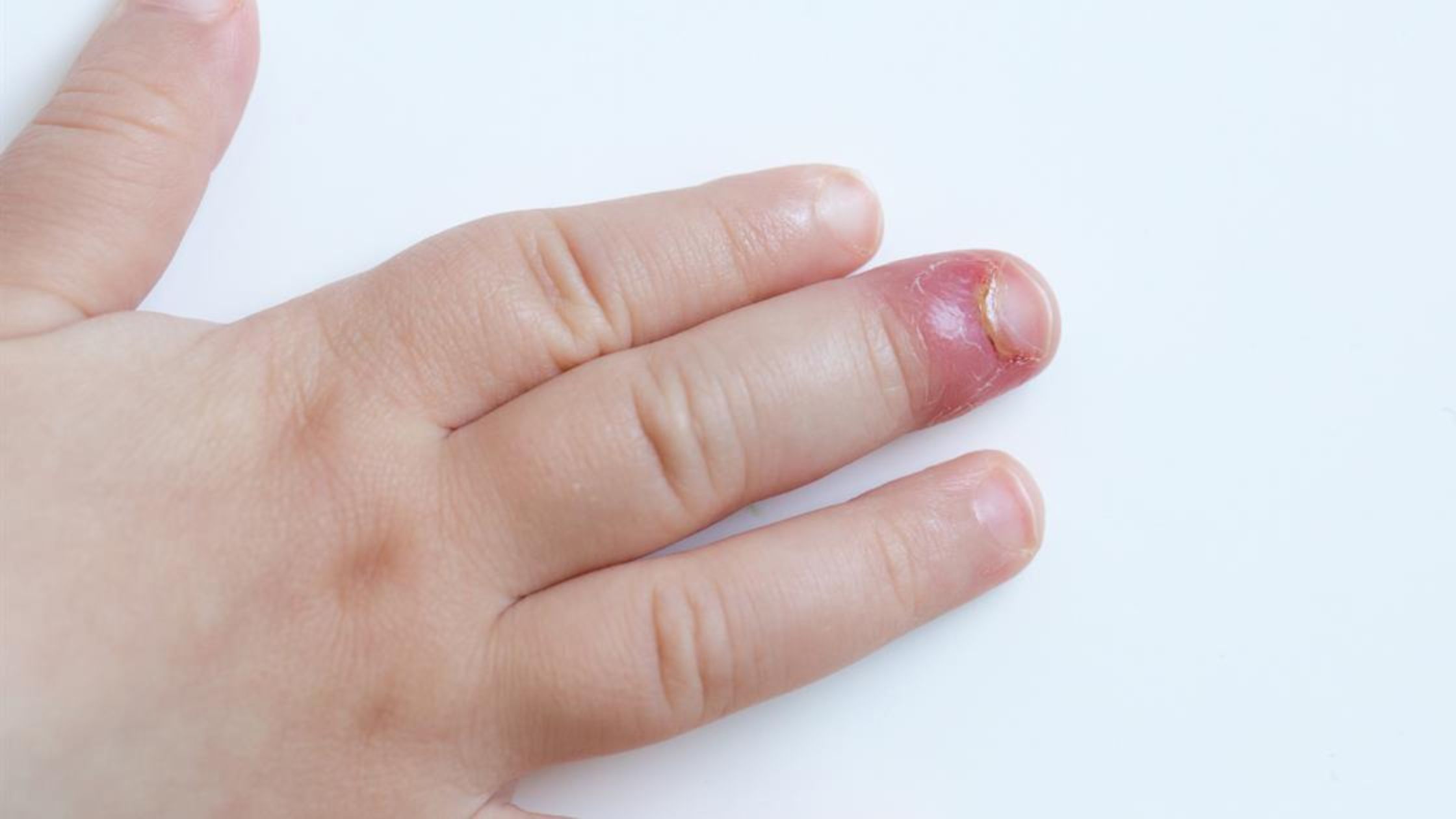 How Do You Know If You Have An Ingrown Fingernail