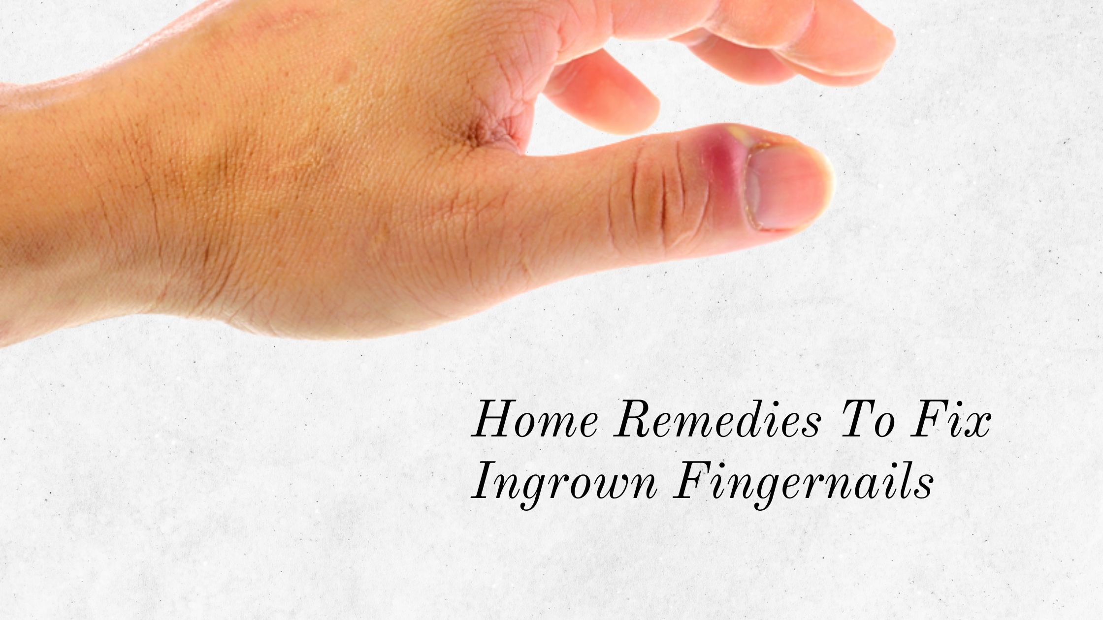 How To Treat Ingrown Fingernails At Home