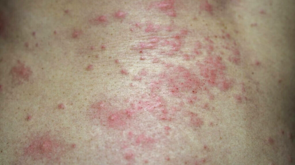 Bacterial Skin Rash - Causes, Remedies, And Treatments Revealed!