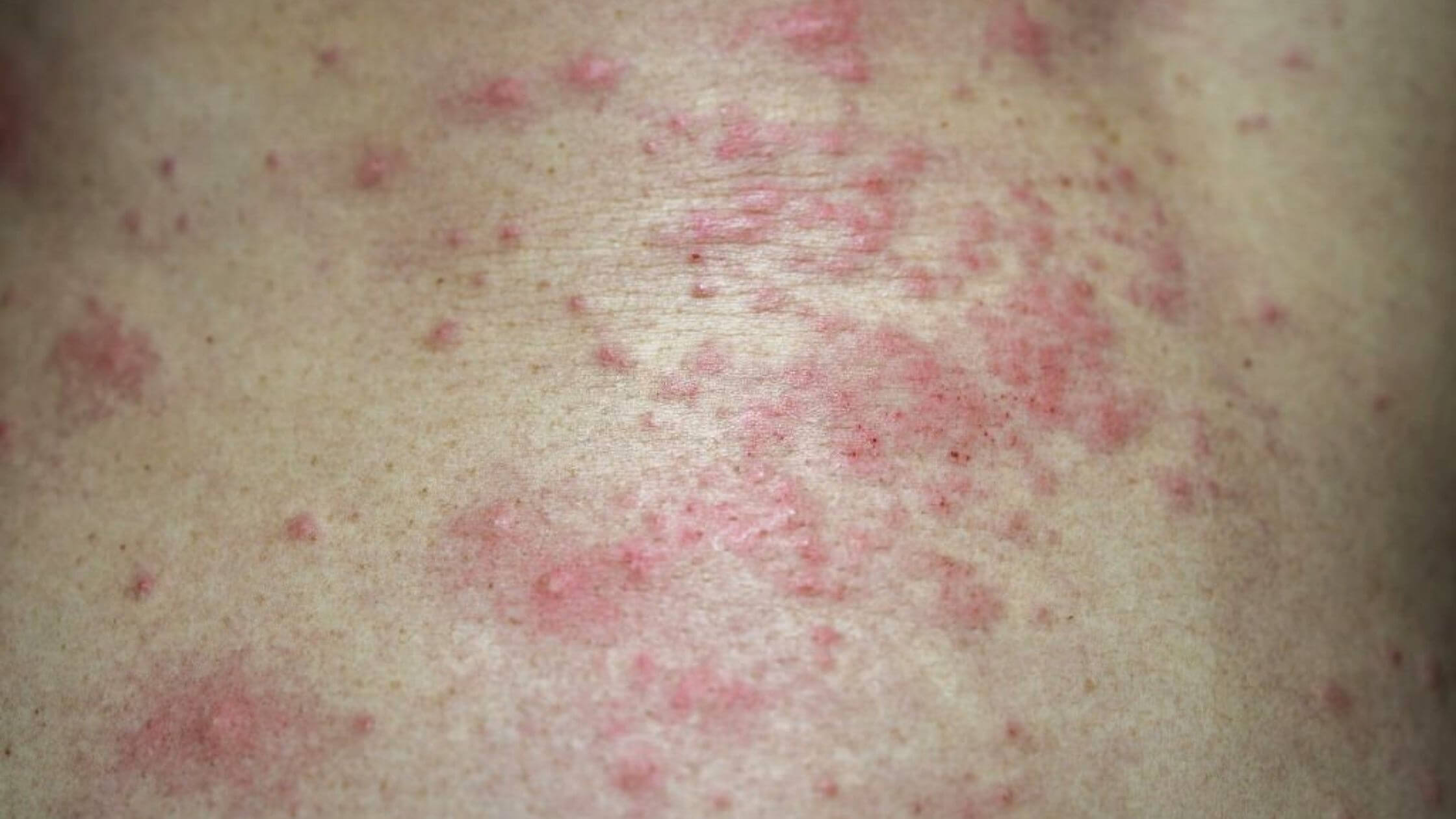 Infections That Cause Bacterial Skin Rash