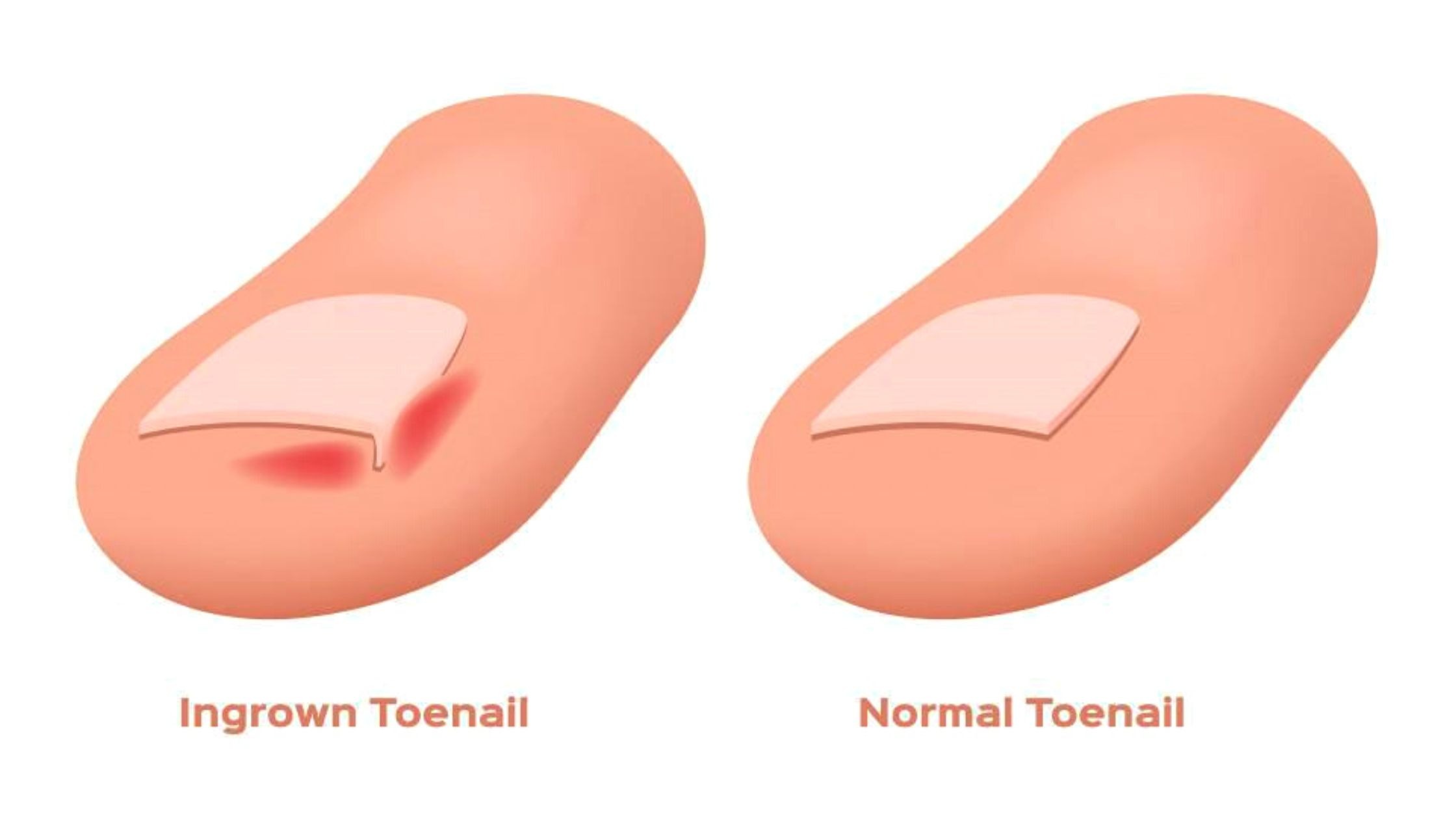 Ingrown Fingernail Symptoms