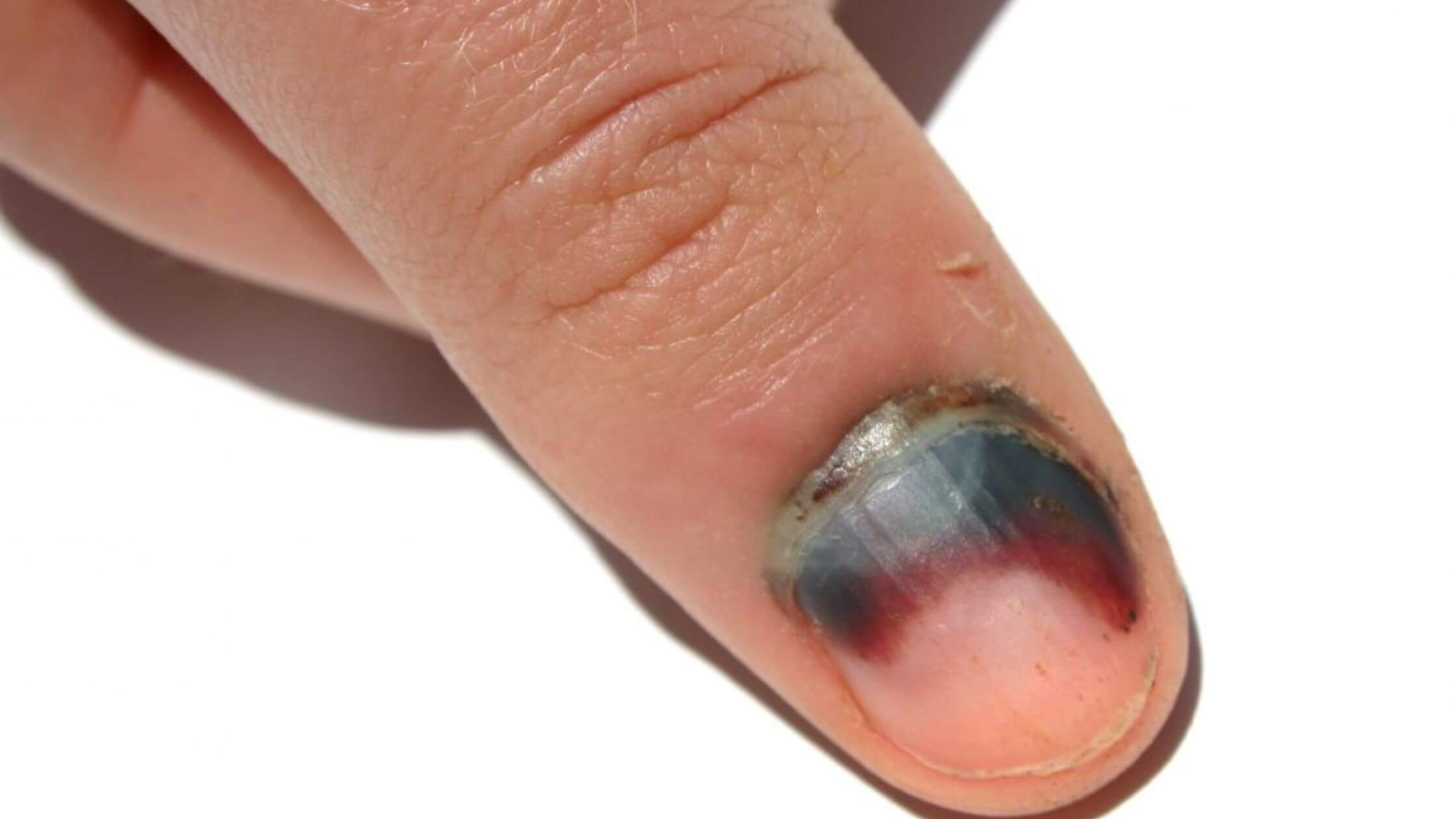 Injury Of The Fingernail 