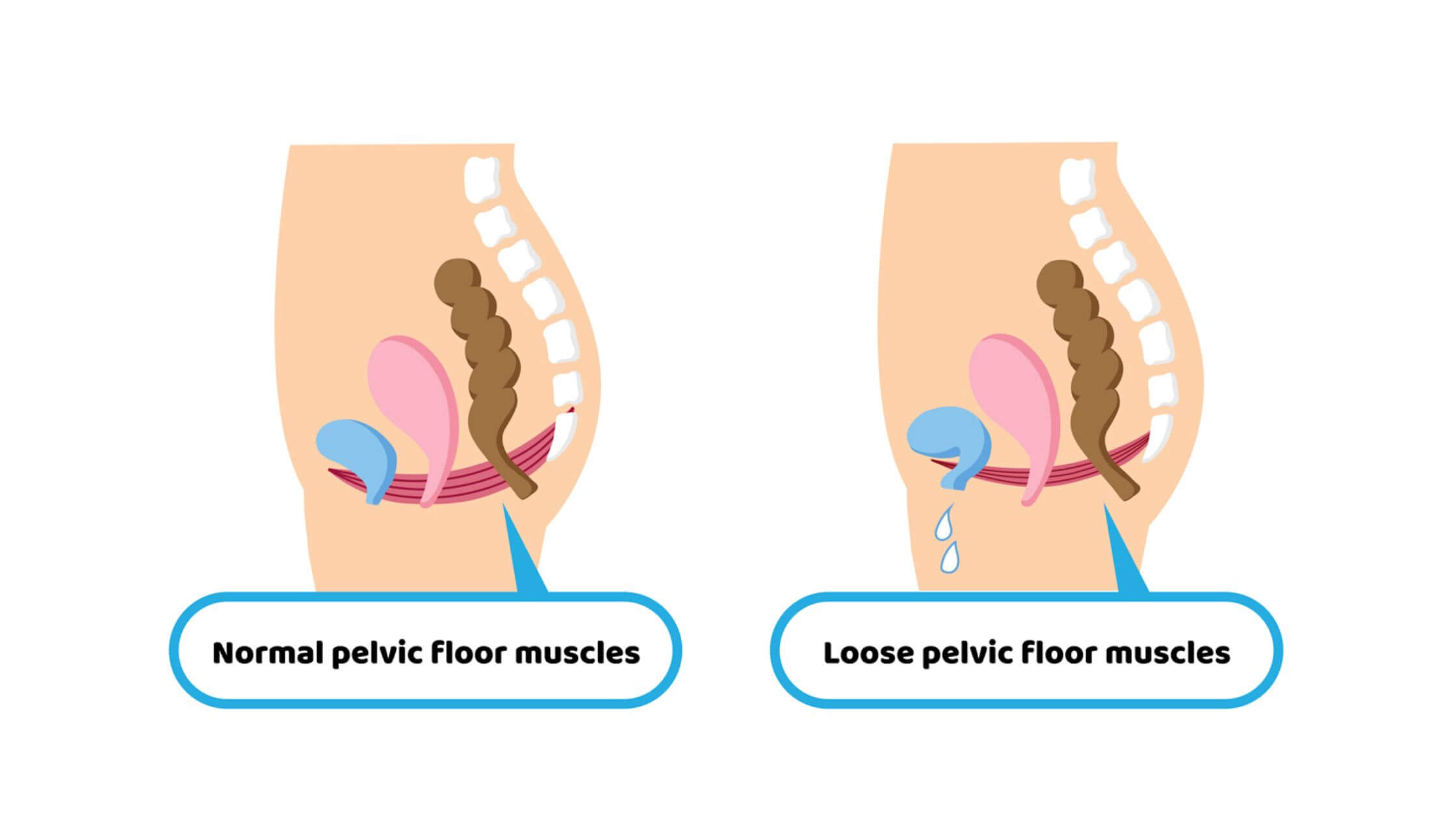 Low Tone Disorders