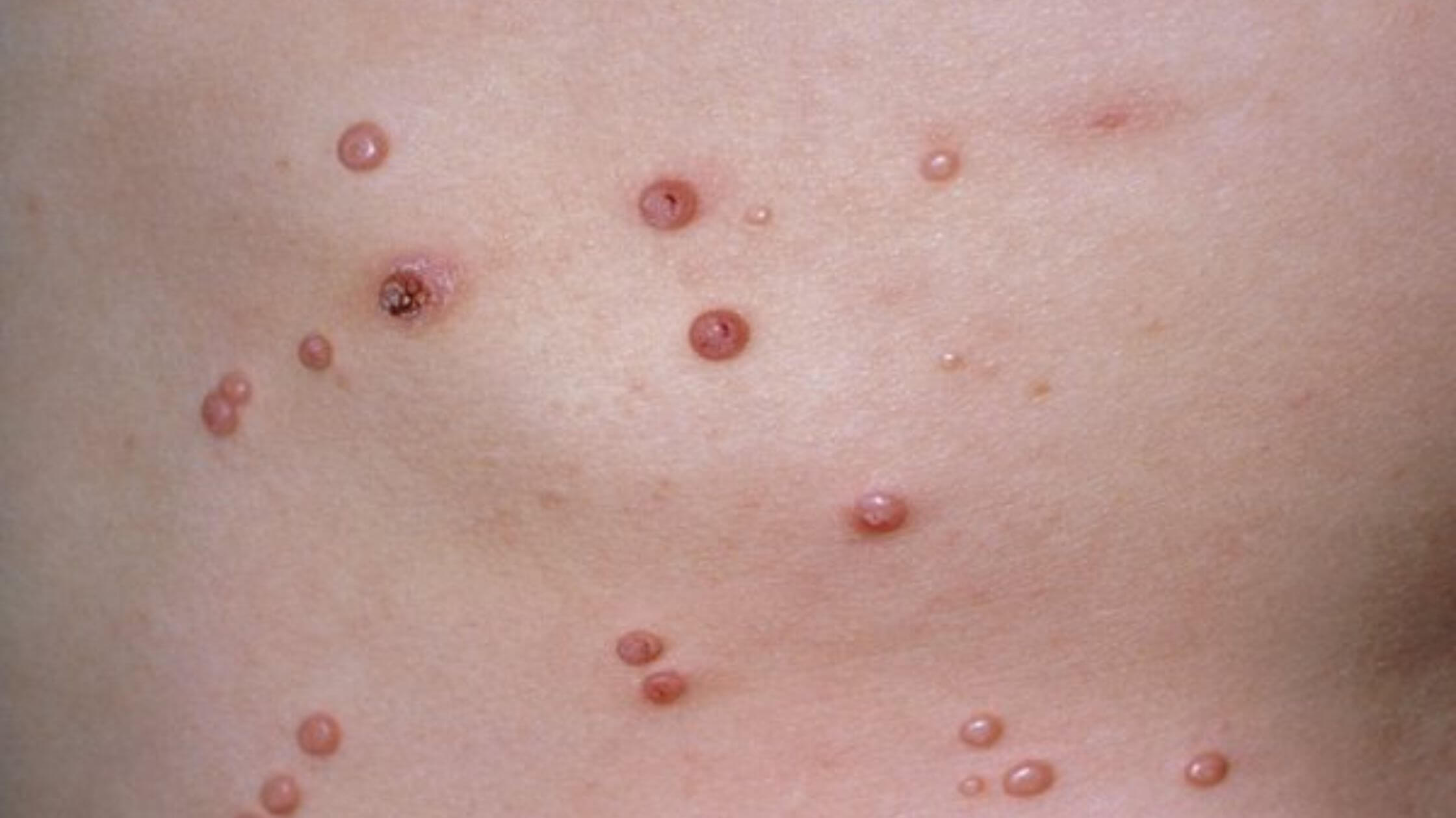 Molluscum Contagiosum