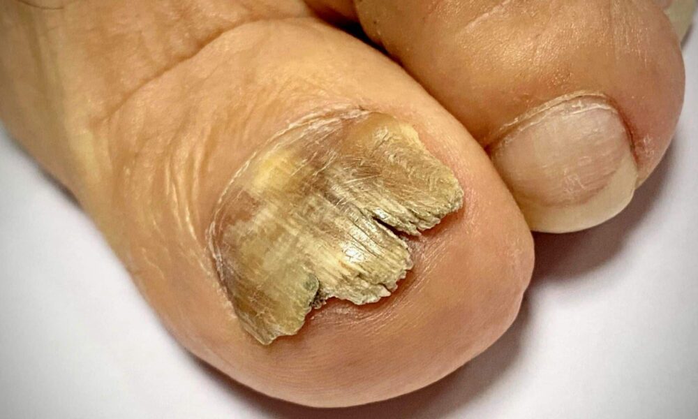 Treatments For Nail Fungal Infection - Various Types Of Treatments
