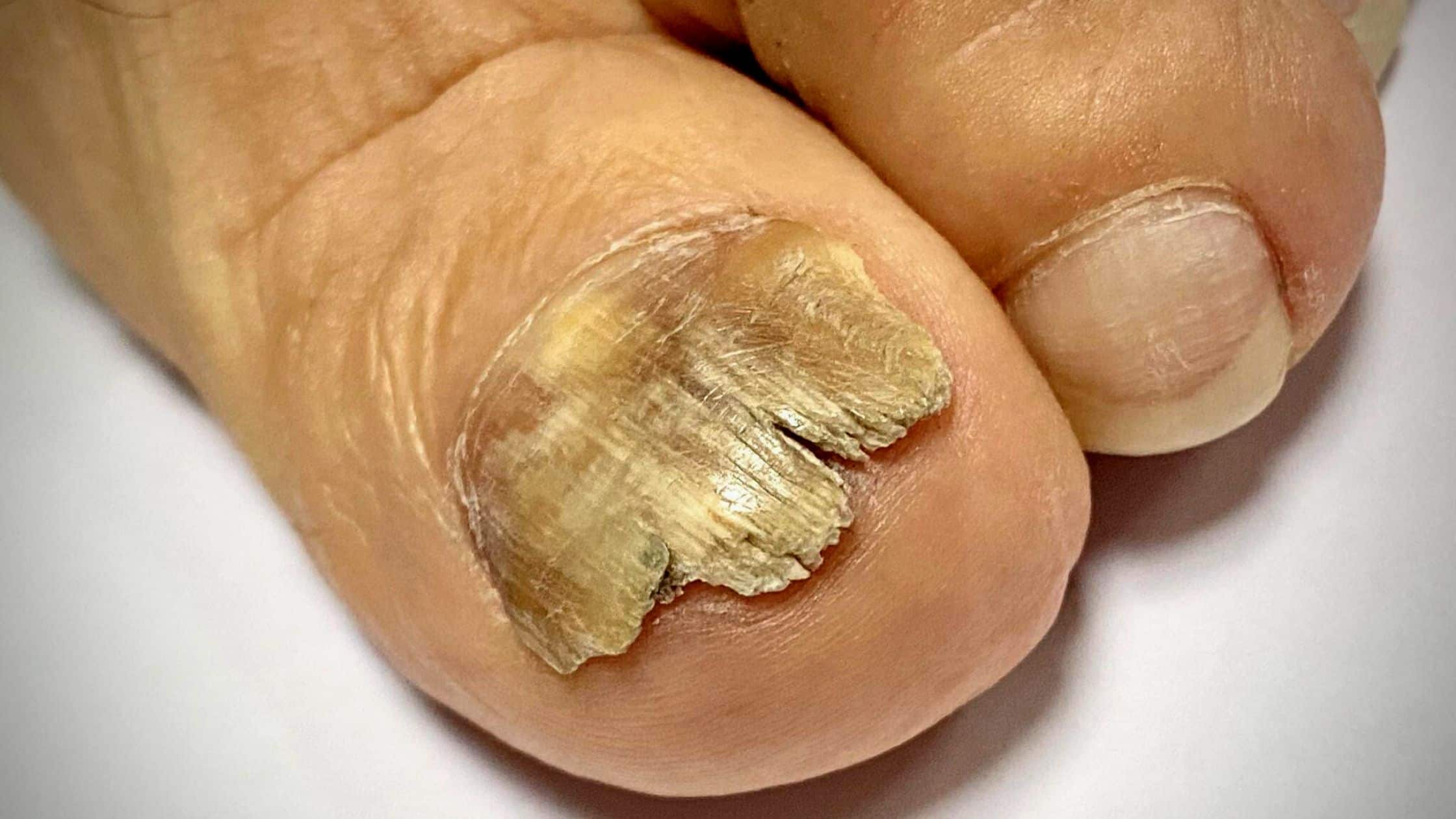 Treatments For Nail Fungal Infection - Various Types Of Treatments