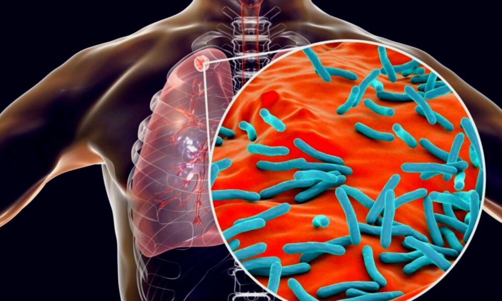 WHO Cases Of Tuberculosis Are Increasing For The First Time In Years