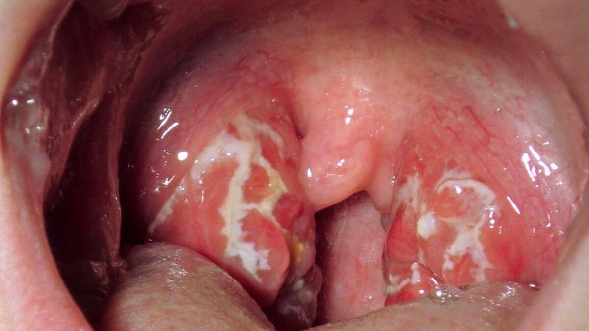 White Spots On Tonsils