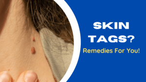 How To Get Rid Of Skin Tags? Tips And Tricks To Follow!