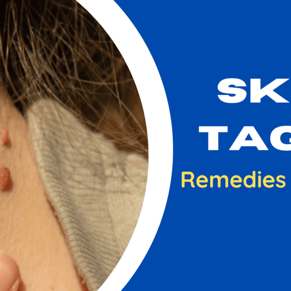How To Get Rid Of Skin Tags? Tips And Tricks To Follow!