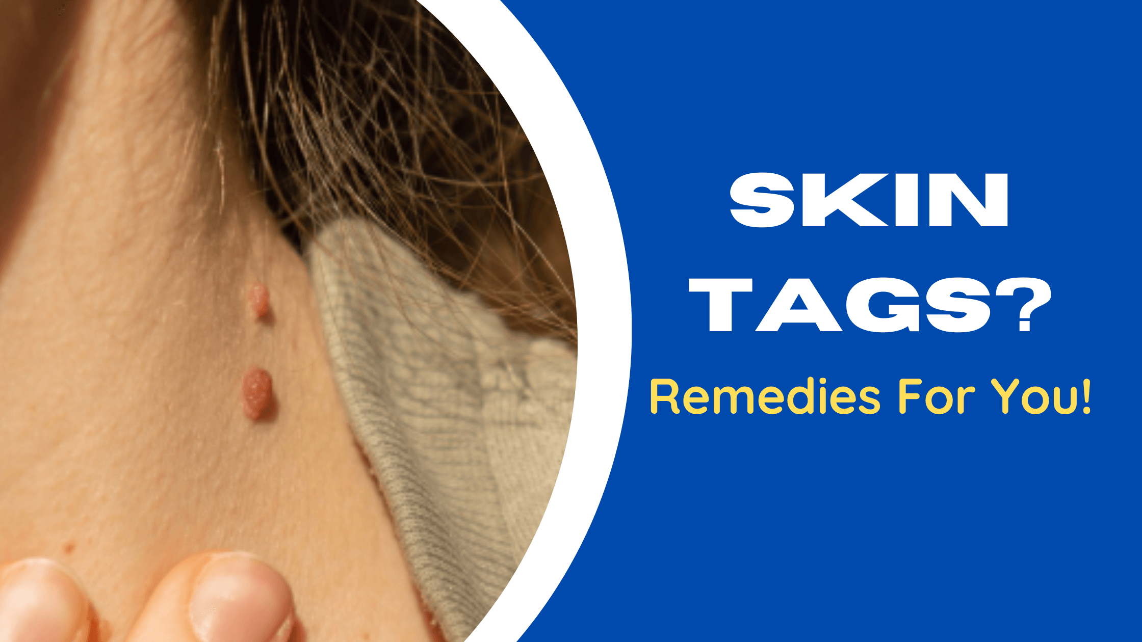 How To Get Rid Of Skin Tags