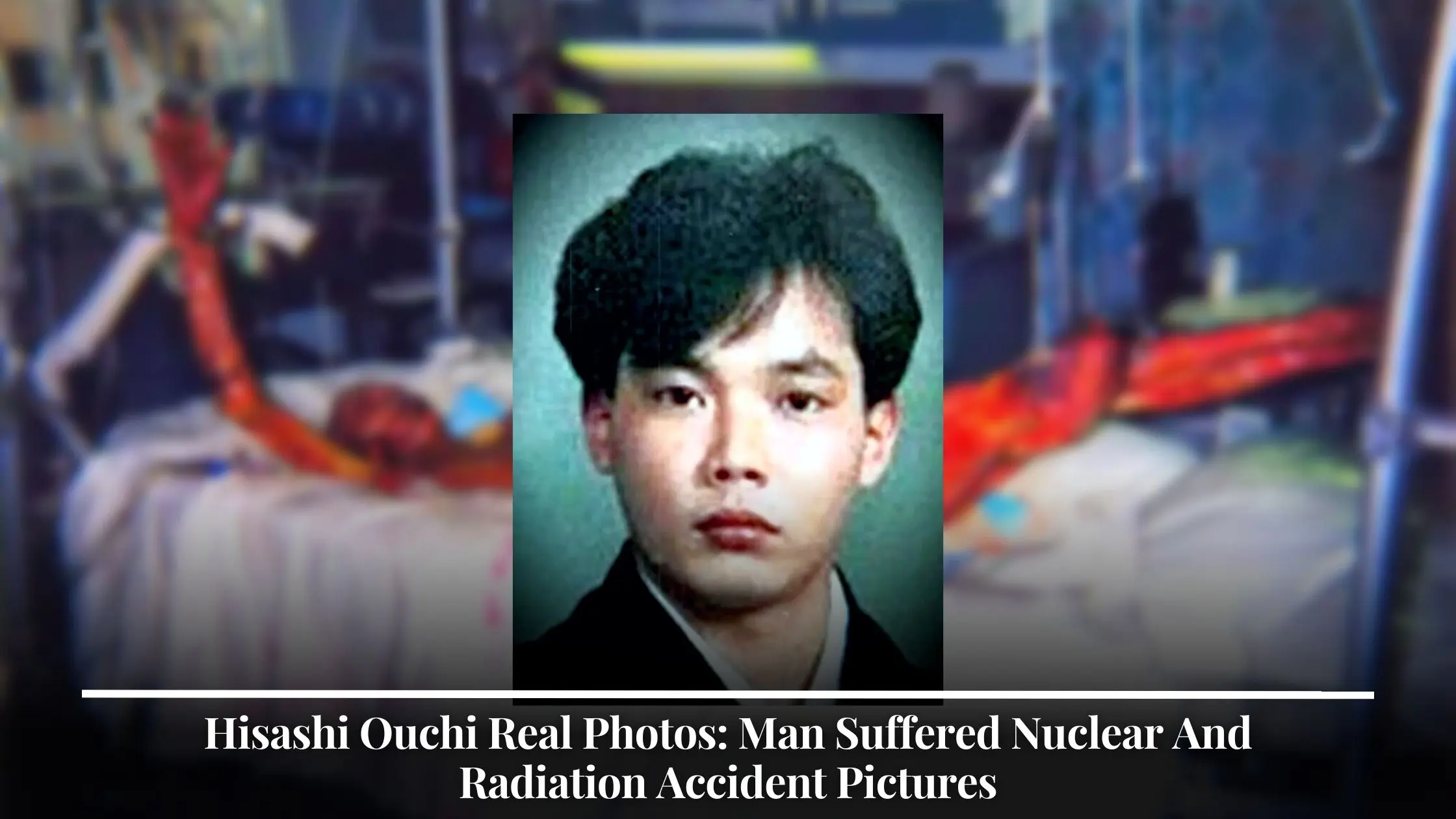 Hisashi Ouchi Real Photos Man Suffered Nuclear And Radiation Accident Pictures
