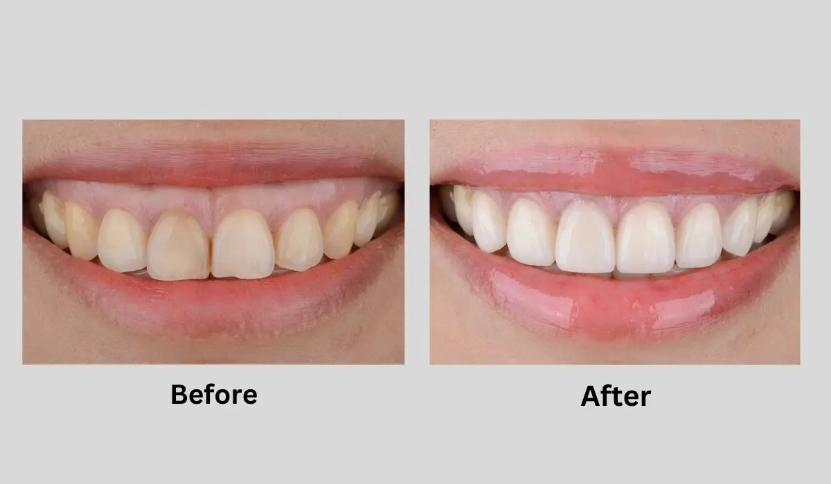 Gum Restore Plus Before And After