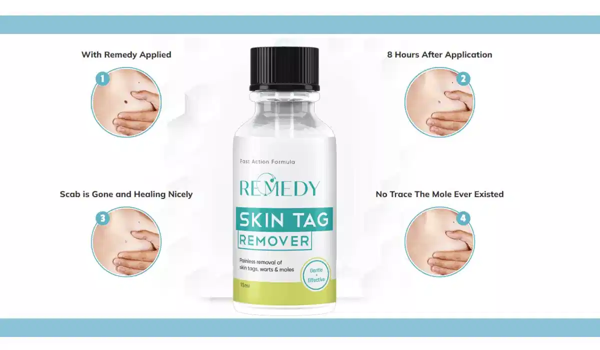 Remedy Skin Tag Remover 