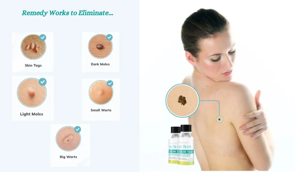 Remedy Skin Tag Remover Supplements Working