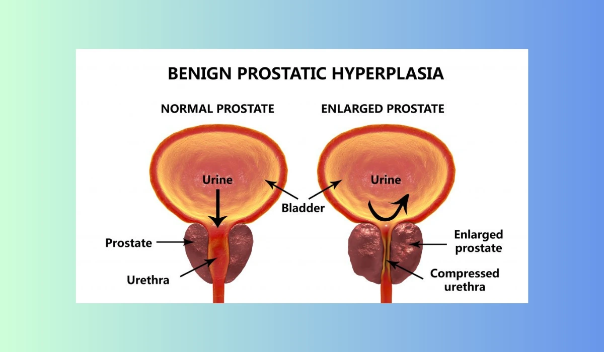 Impact Of Prostate Health Problems