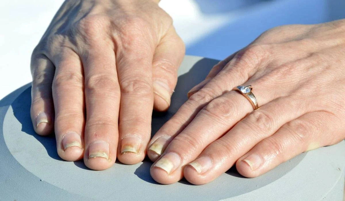 How To Get Rid Of Nail Psoriasis