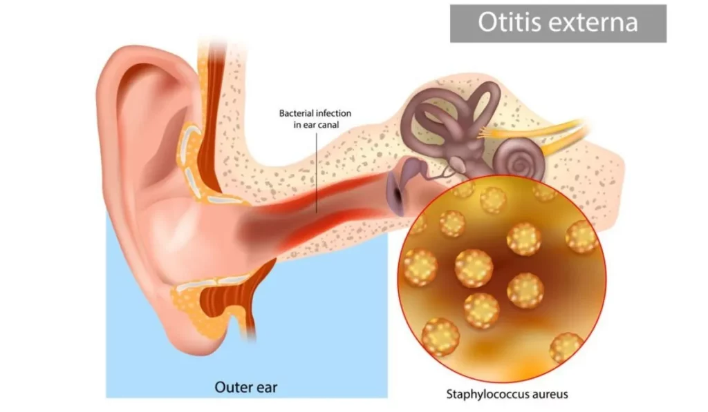 Types of Ear Infections Causes and Symptoms